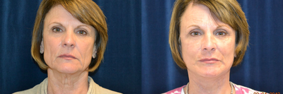 Facelift before and after photo