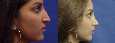 Rhinoplasty before and after photo