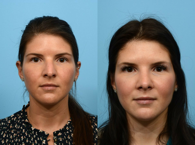 Alarplasty before and after photo