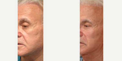 Cheek Augmentation before and after photo