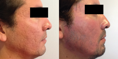 Fractional Laser before and after photo