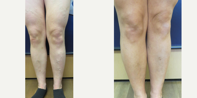 Sclerotherapy before and after photo