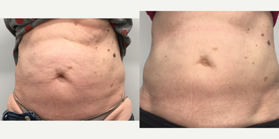 SculpSure before and after photo