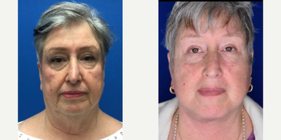 SMAS Facelift before and after photo