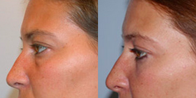 Eyelid Surgery before and after photo
