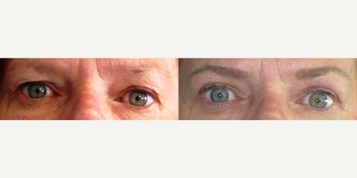 Eyelid Surgery before and after photo