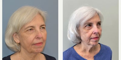 Eyelid Surgery before and after photo