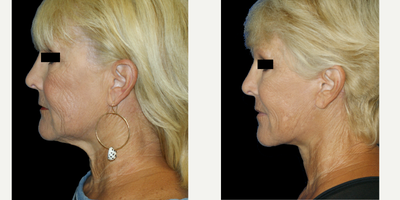 Facelift before and after photo