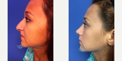Rhinoplasty before and after photo