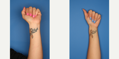 Tattoo Removal before and after photo