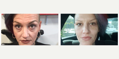 Voluma before and after photo