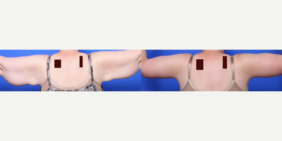 Arm Lift before and after photo