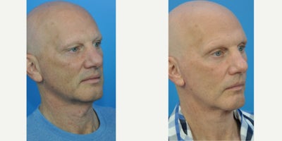 Eyelid Surgery before and after photo