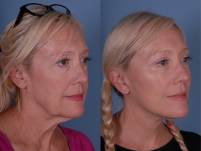 Mini Facelift before and after photo