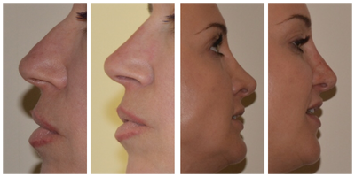 Nonsurgical Nose Job before and after photo