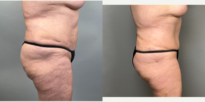 Brazilian Butt Lift before and after photo