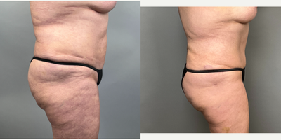 Brazilian Butt Lift before and after photo