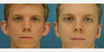 Ear Surgery before and after photo