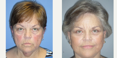 Facelift before and after photo