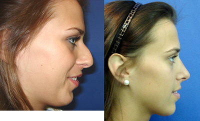 Rhinoplasty before and after photo