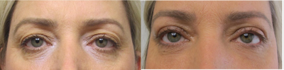 Eyelid Surgery before and after photo