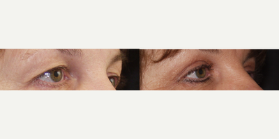 Eyelid Surgery before and after photo