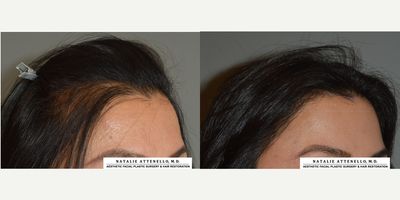 Forehead Reduction before and after photo