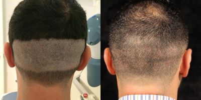 FUE Hair Transplant before and after photo