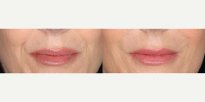 Restylane before and after photo