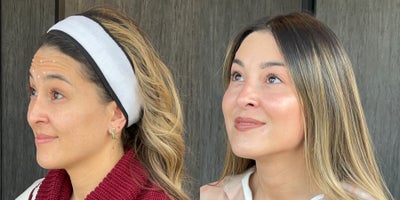 Botox before and after photo