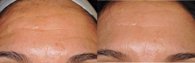 Clear and Brilliant before and after photo