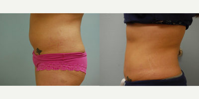 Liposuction before and after photo