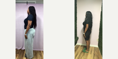 Obalon Intragastric Balloon before and after photo