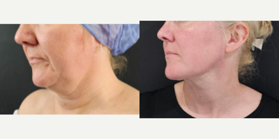 Renuvion before and after photo