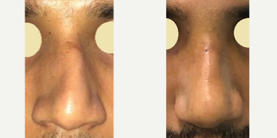 Revision Rhinoplasty before and after photo