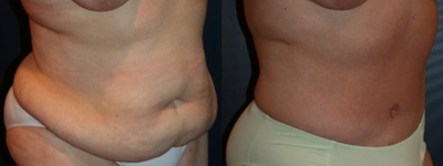 Tummy Tuck before and after photo