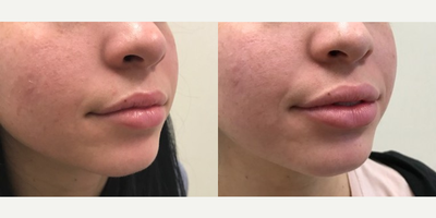 Vollure before and after photo