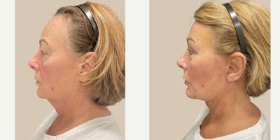 Arm Lift before and after photo