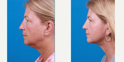 before and after image