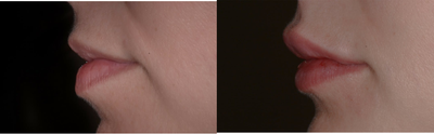 Lip Fillers before and after photo