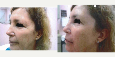 Nonsurgical Facelift before and after photo