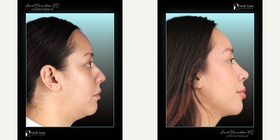 Rhinoplasty before and after photo