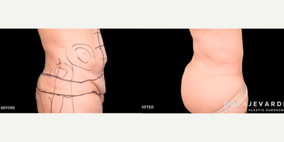 Tummy Tuck before and after photo