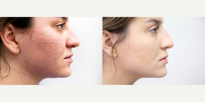 CO2 Laser before and after photo