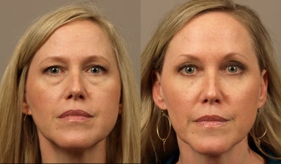 Eyelid Surgery before and after photo