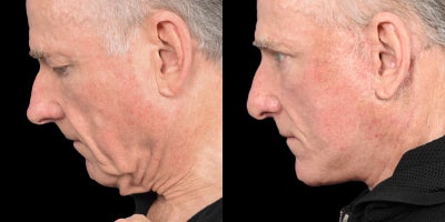 Eyelid Surgery before and after photo