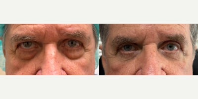 Eyelid Surgery before and after photo