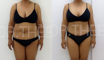 Mommy Makeover before and after photo