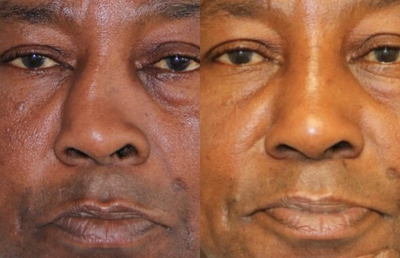 Septoplasty before and after photo