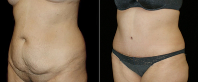 Tummy Tuck before and after photo